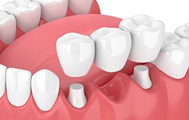 Digital model of fixed dental bridge