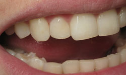 Cosmetic Bonding Results - Case 2