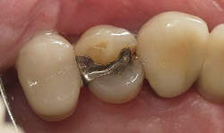 Tooth-Colored Fillings - Case 3