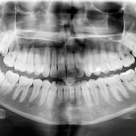 x-ray of full mouth