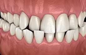 Illustration of a crossbite