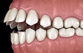 Illustration of an open bite