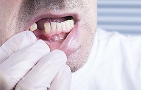 Close up of man with a missing lower tooth