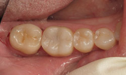 CEREC Crowns Results- Case 1