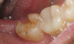 CEREC Crowns - Case 1