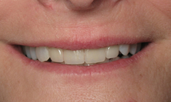 Porcelain Veneers Results - Case 4