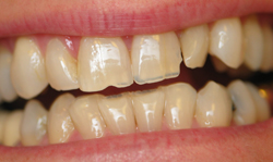 Porcelain Veneers before - Case 4