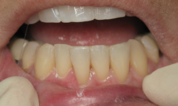 Smile Makeover Results - Case 2