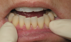 Smile Makeover - Case 2