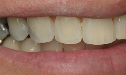 Cosmetic Bonding Results - Case 3
