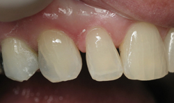 Cosmetic Bonding - Case 3