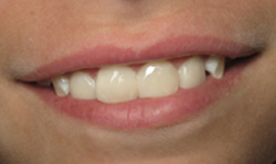 Cosmetic Bonding Results - Case 4