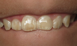 This boy got teased every day at school about his teeth. After bonding, he feels safe to smile again. Cosmetic Bonding - Case 4