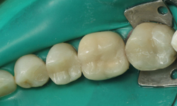 Tooth-Colored Fillings Results - Case 4