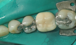 Tooth-Colored Fillings - Case 4