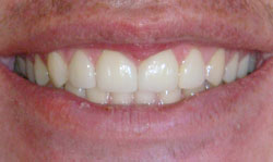 Porcelain Veneers Results - Case 1