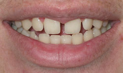 Porcelain Veneers before - Case 1