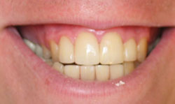 Porcelain Veneers Results - Case 2