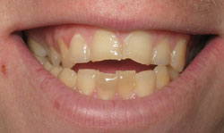 Porcelain Veneers before - Case 2