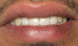 Porcelain Crowns Results - Case 1