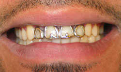 Porcelain Crowns before - Case 1