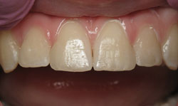 Tooth-Colored Fillings Results - Case 2