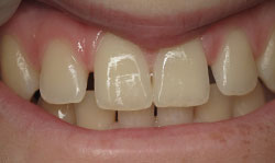 Tooth-Colored Fillings - Case 2