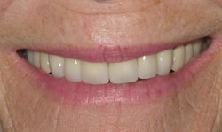 Smile Makeover Results - Case 1