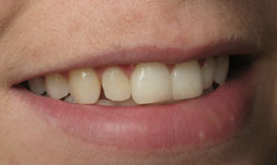 Cosmetic Bonding - Case 2