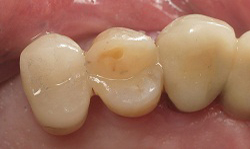 Tooth-Colored Fillings Results - Case 3