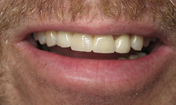Tooth-Colored Fillings Results - Case 1