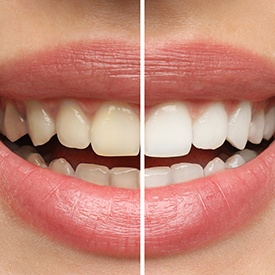 Woman's smile before and after teeth whitening