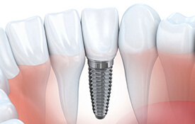 illustration of implant