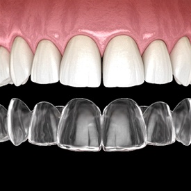 3D illustration of Invisalign in Petaluma