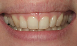 Invisalign Results - Case 1