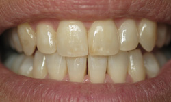 Invisalign Results - Case 2