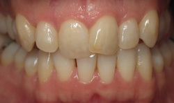 Invisalign - Case 2