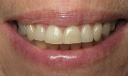Six Month Smile Results - Case 1