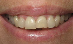 Six Month Smile - Case 1