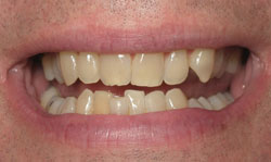 Six Month Smile - Case 2