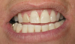 Six Month Smile Results - Case 3