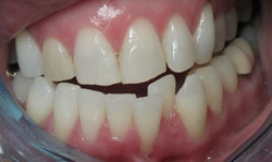 Six Month Smile - Case 3