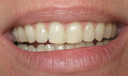 Six Month Smile Results - Case 4