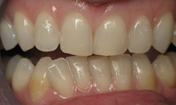 Six Month Smile - Case 4