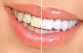 Smile before and after teeth whitening
