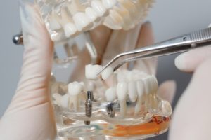 Does Insurance Cover Dental Implants?