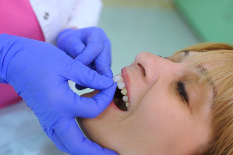 dentist attaching veneers to patient’s teeth in Petaluma