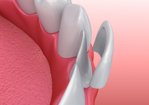 Model of veneer in front of tooth