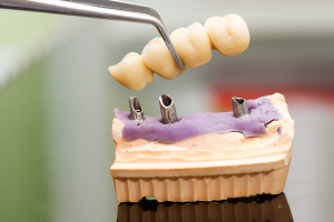 a closeup of a dental bridge 